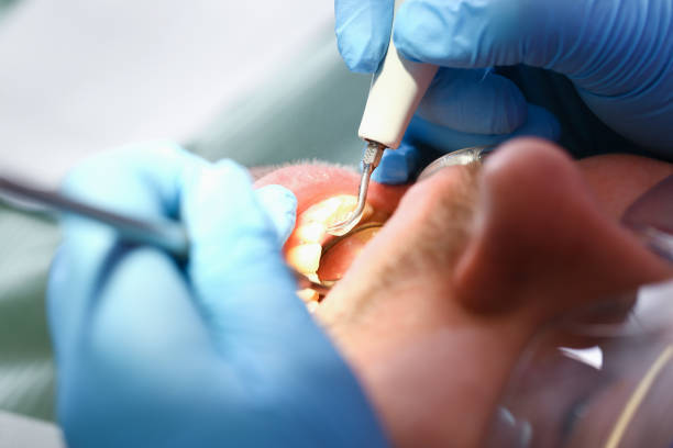 Best Emergency Wisdom Tooth Extraction in Fmington, AR