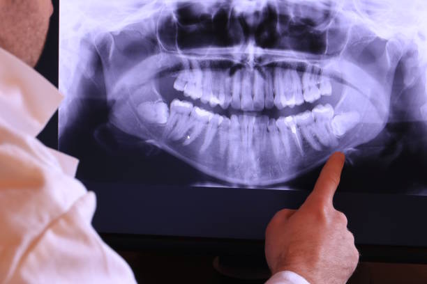Best Knocked-Out Tooth (Avulsed Tooth) Treatment in Fmington, AR