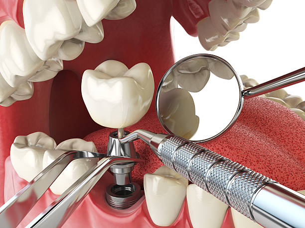 Best Broken or Chipped Tooth Repair in Fmington, AR